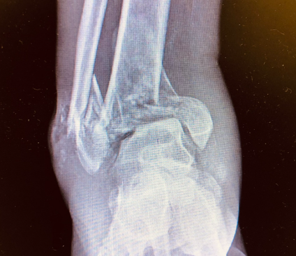 An x-ray image of a fractured ankle