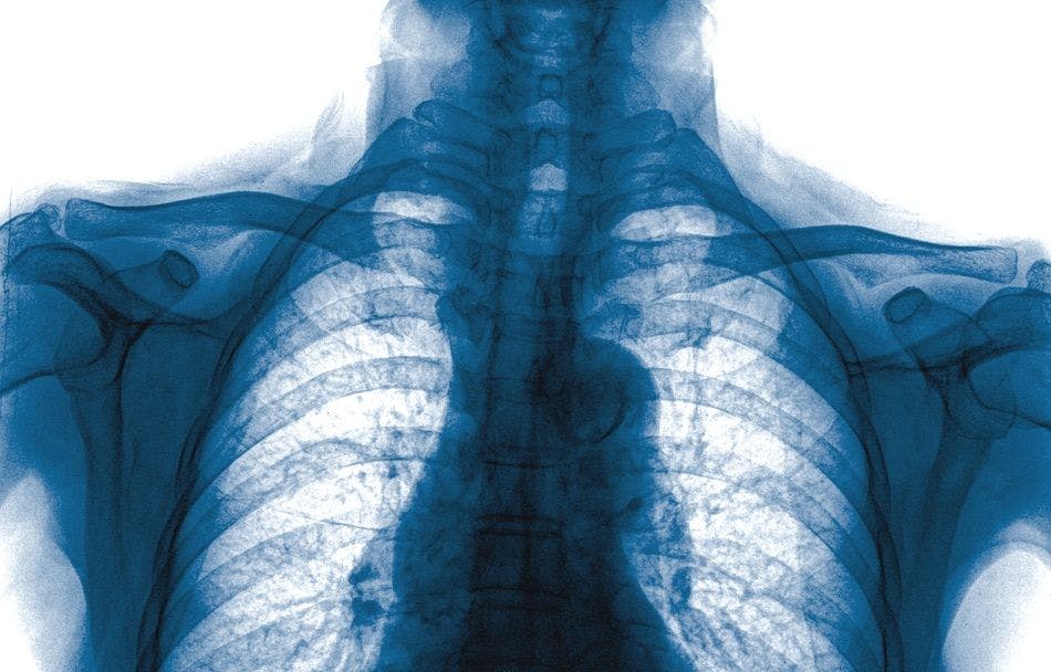 Treatment for systemic sclerosis lung disease.   (©Thailoei92ShutterStock.com)