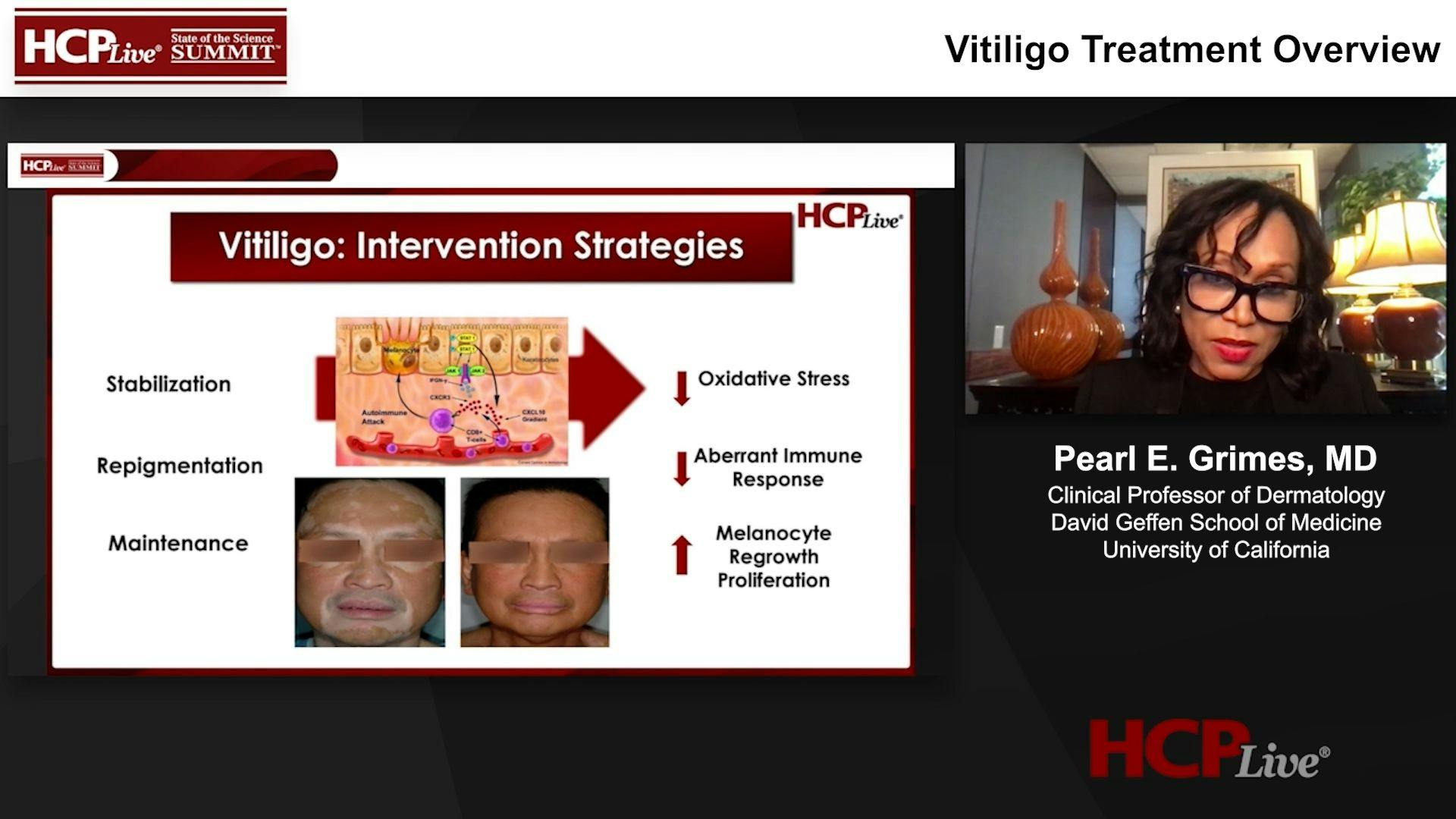Vitiligo Treatment Overview