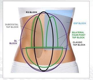 ESP, erector spinae plane; QL, quadratus lumborum; RS, rectum sheath; TAP, transversus abdominis plane.