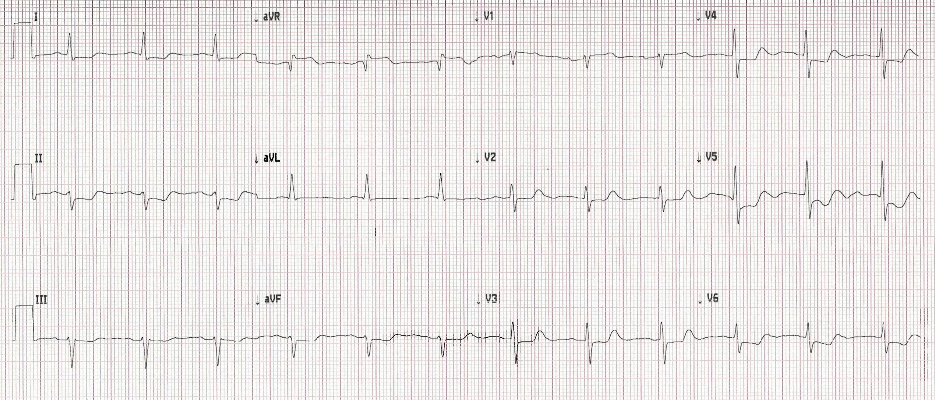 Printout of an ECG from patient featured in case report.