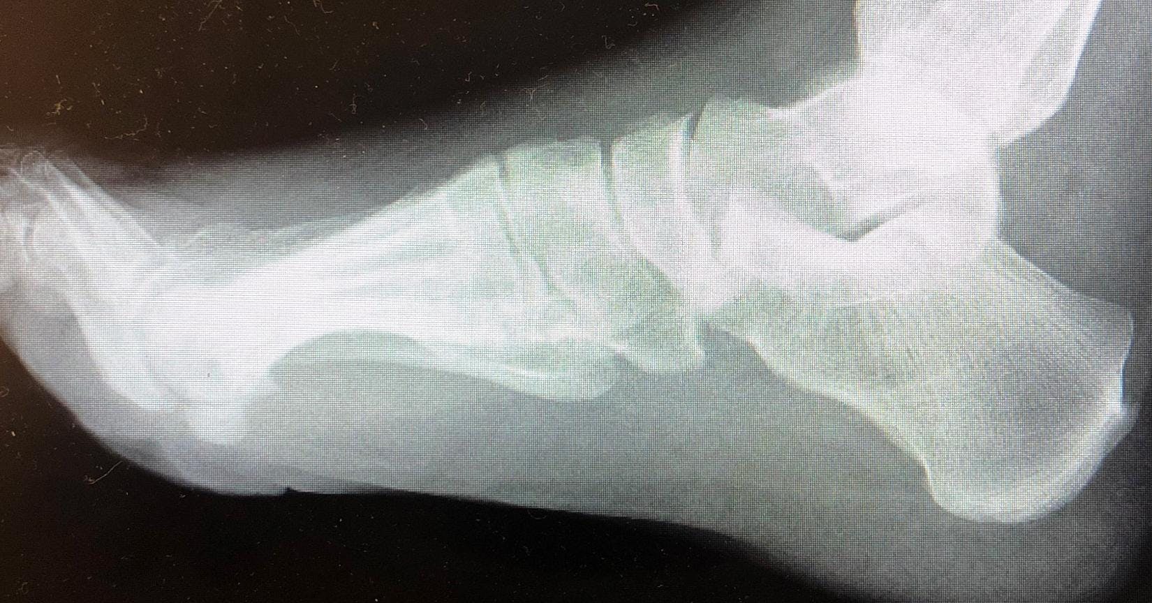 X-ray of a foot