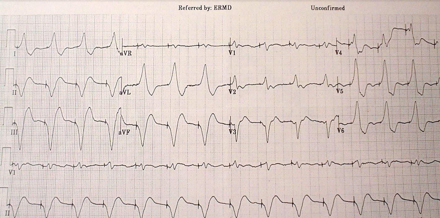 EKG chest pain