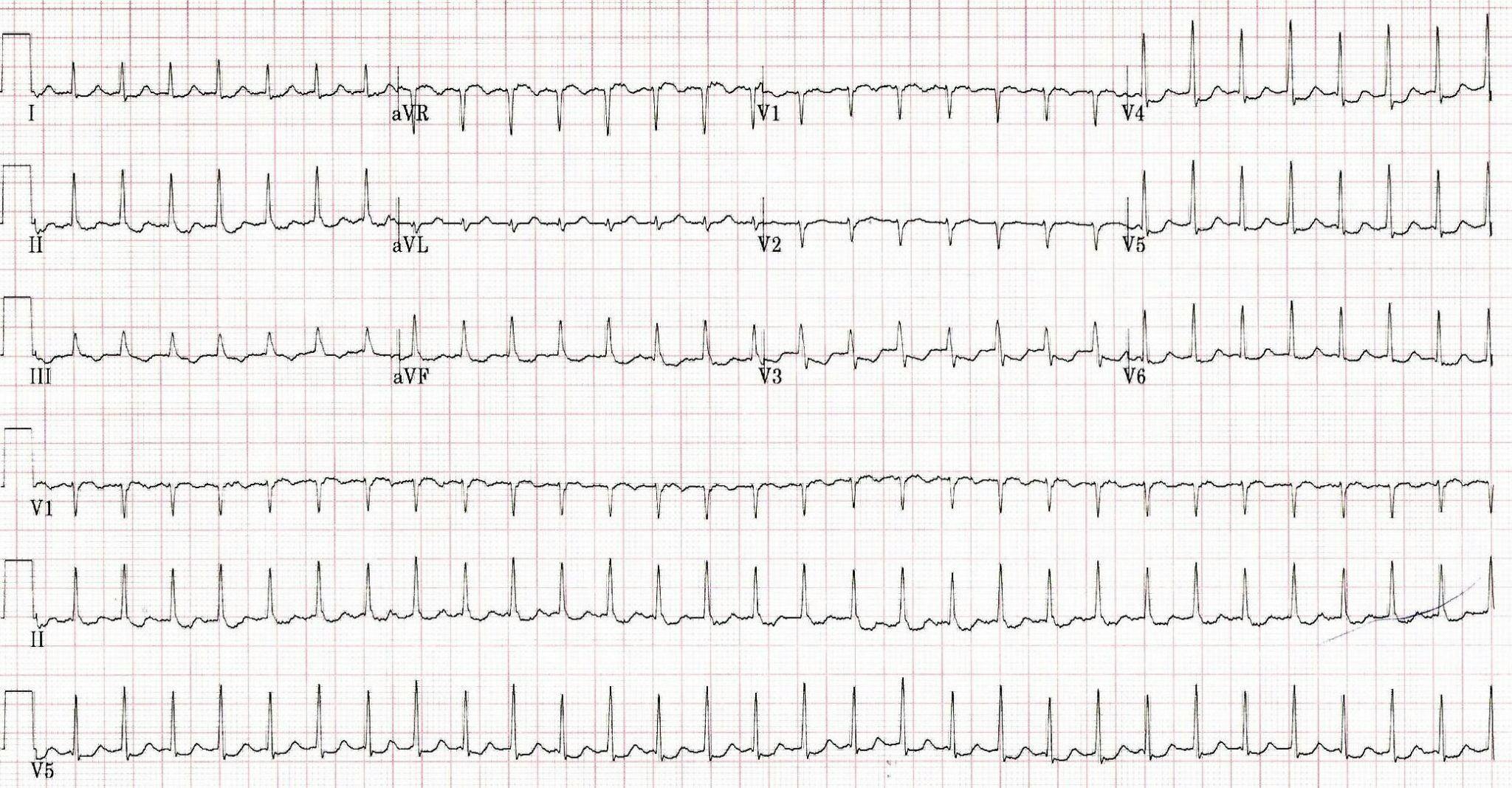 ECG printout of a patient with chest pain. Computer Read: Sinus tach at 179, ST & T wave abnormality, consider inferior ischemia. | Credit: Brady Pregerson, MD