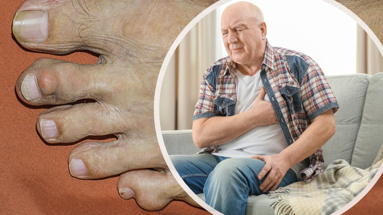 New Data Demonstrates Link Between Gout and Cardiovascular Disease