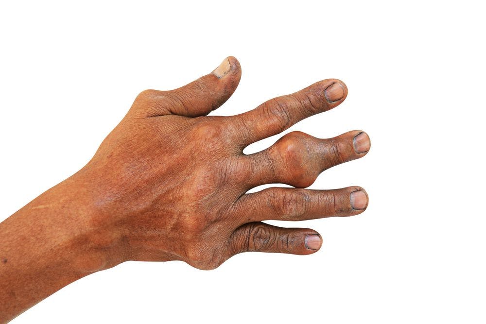 Hand and fingers with gout. Cardiovascular disease, gout linked to readmissions.