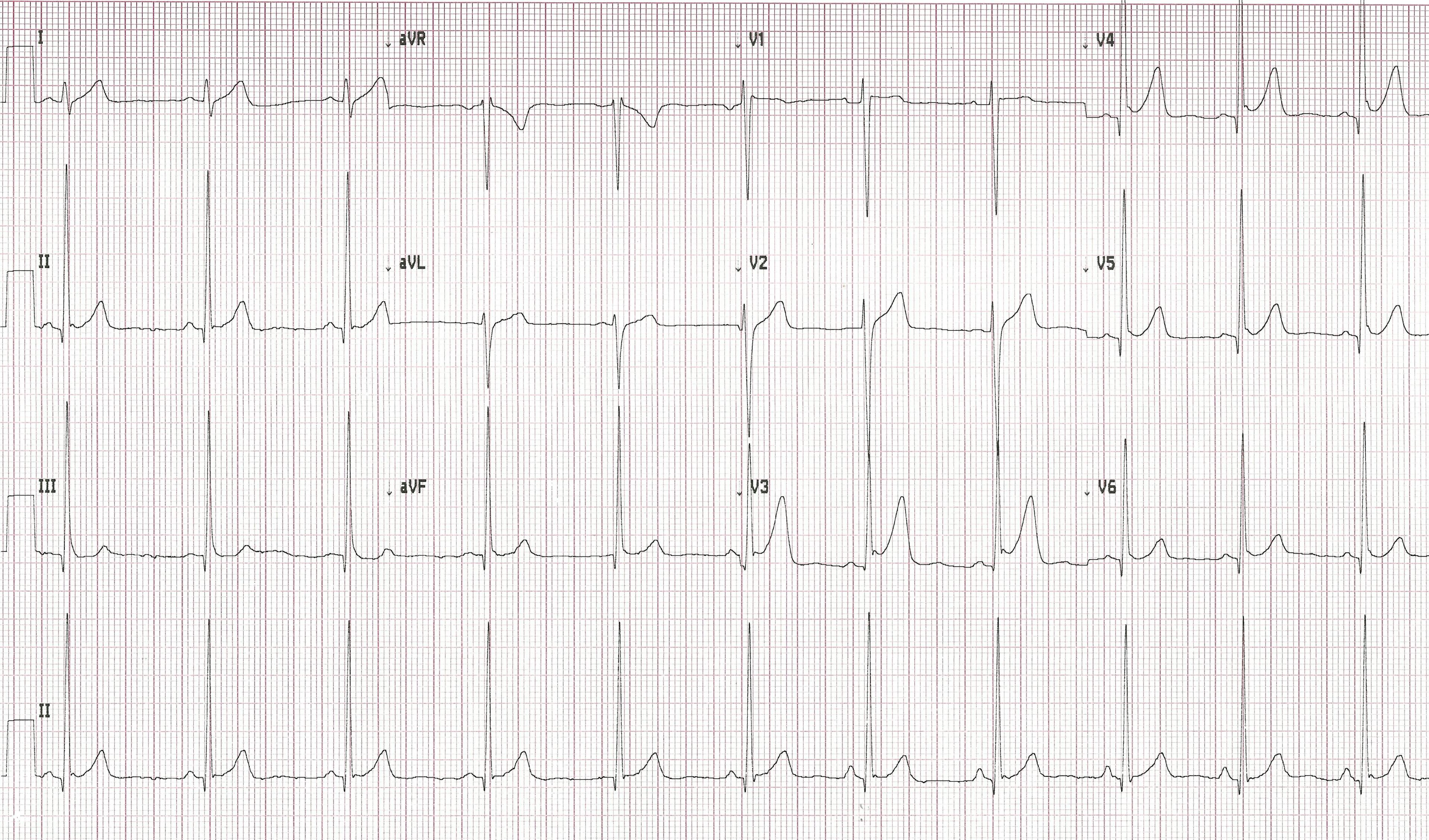 ECG Printout from patient featured in case report. | Credit: Brady Pregerson, MD