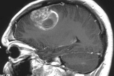 Study Explores Tumor Genotyping in Patients Newly Diagnosed with Glioblastoma