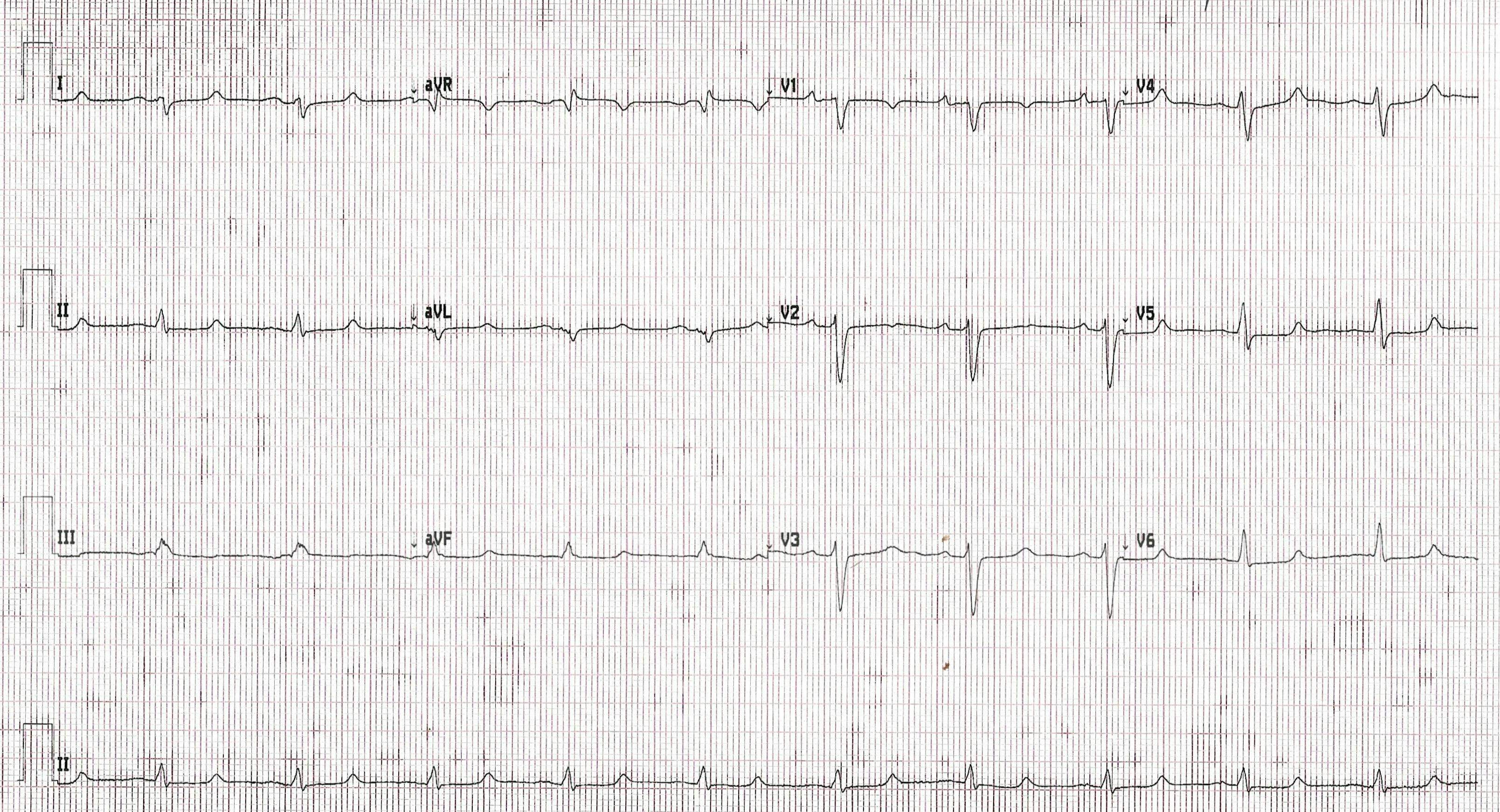 Computer print out of a patient's ECG. | Credit: Brady Pregerson, MD