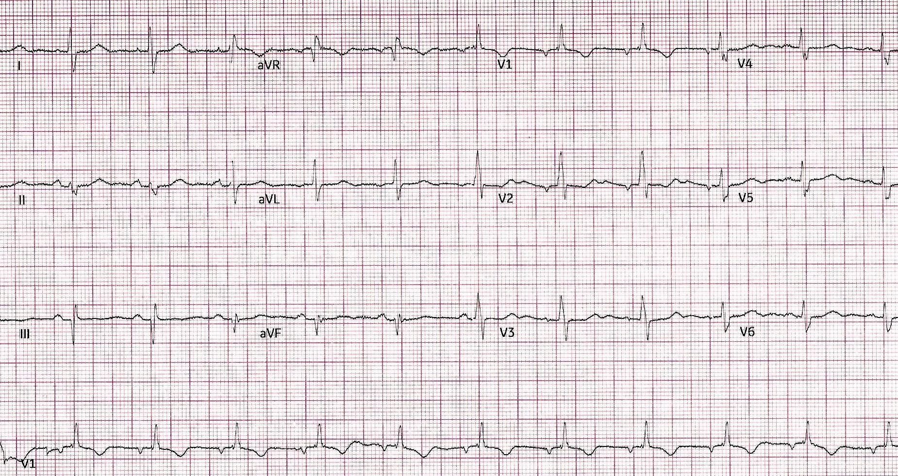 ECG Printout of a patient suffering from an acute coronary syndrome.