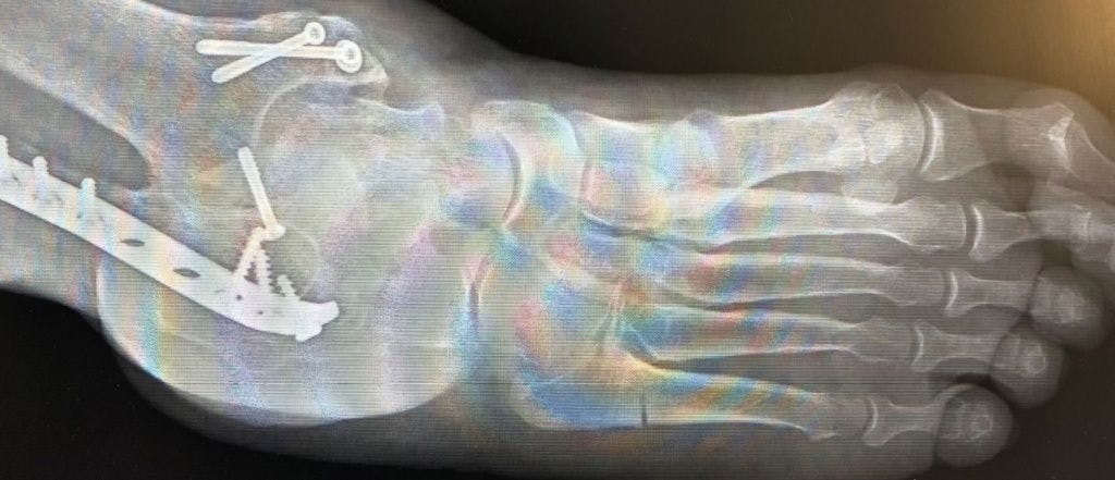 X-ray image of patient's foot