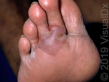 Image IQ:  Diabetes and bulla on the foot