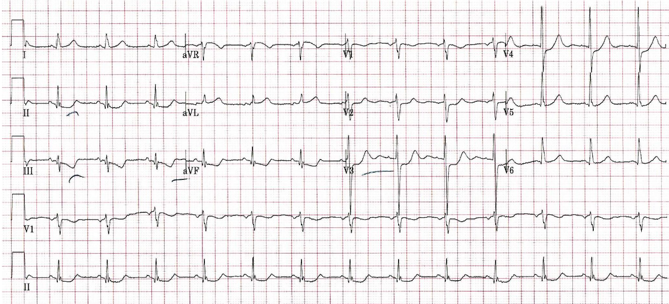 Printout of an ECG from a man in his 60s experiencing a STEMI. Computer Read: NSR 79, ST abnormality possible inferior and anterior subendocardial ischemia.