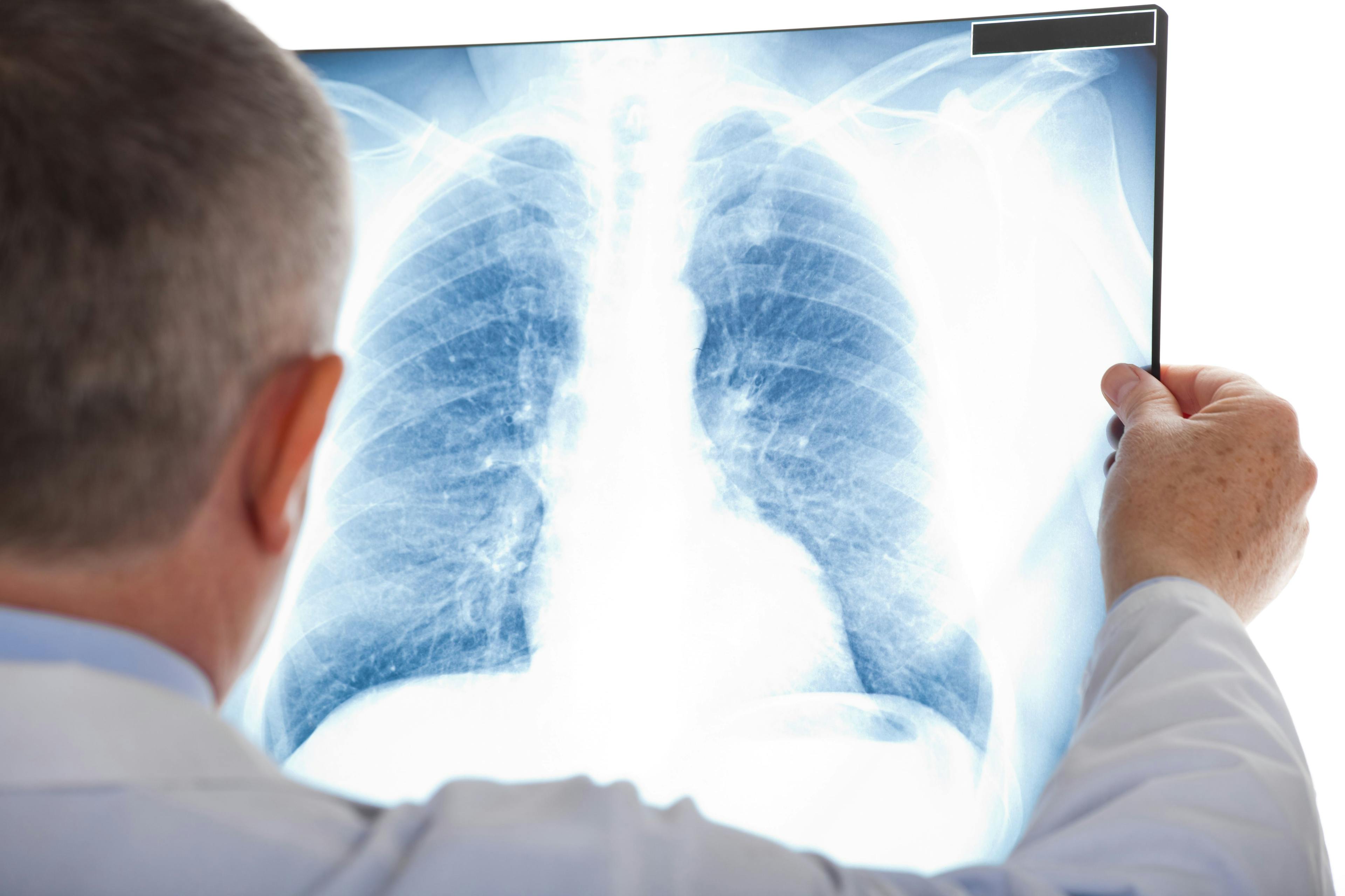 IVC Filter Could Cut Pulmonary Embolism Risk in Cancer-Related DVT