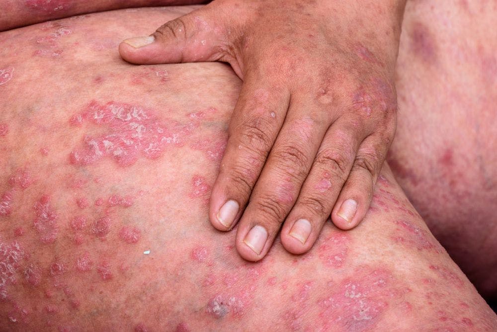 Severe Psoriasis Associated with Increased Risk of Advanced Liver Fibrosis 