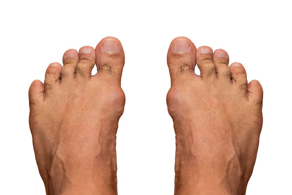 Gout, a common comorbidity in renal transplant patients.
