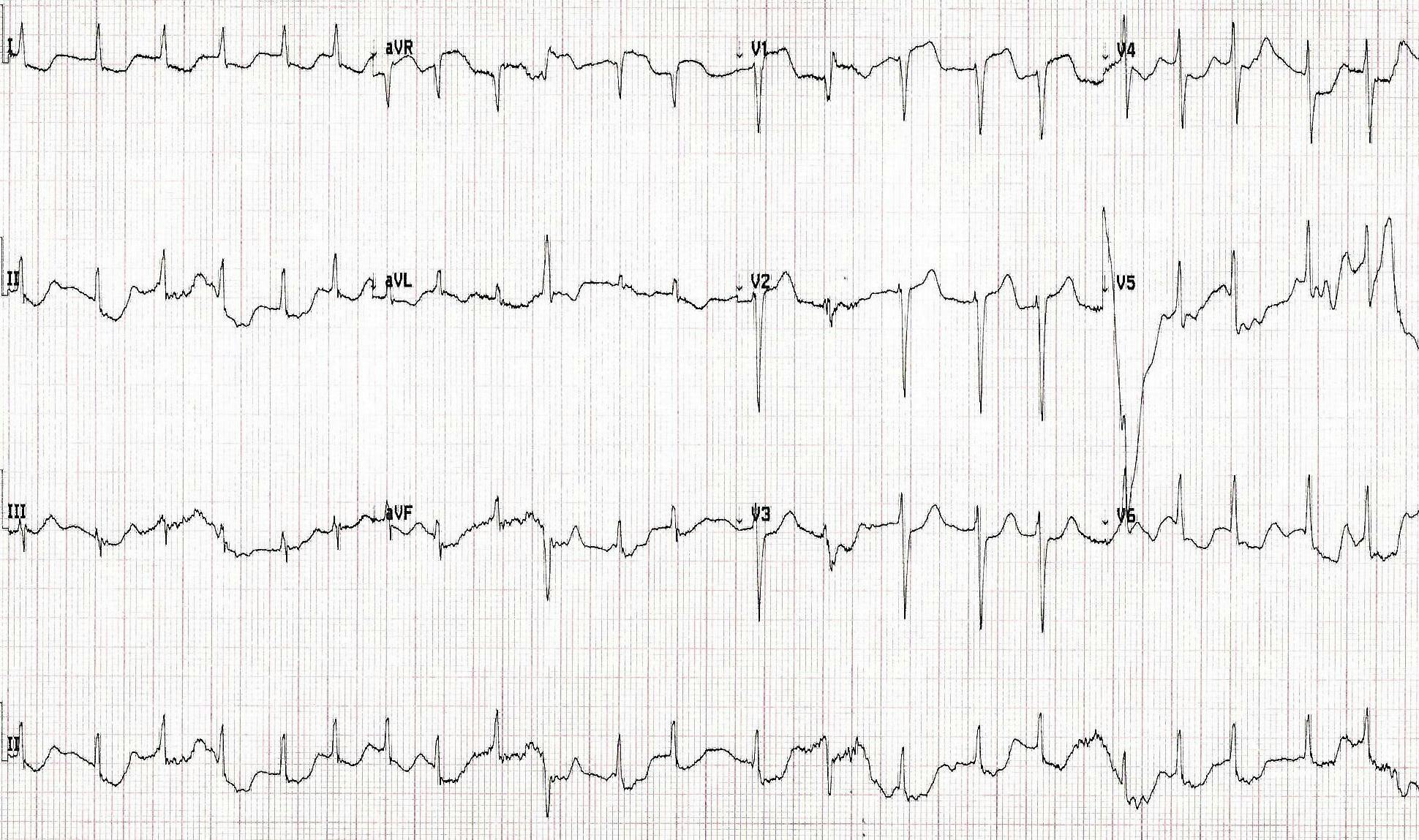 ECG of patient experiencing an acute myocardial infarction