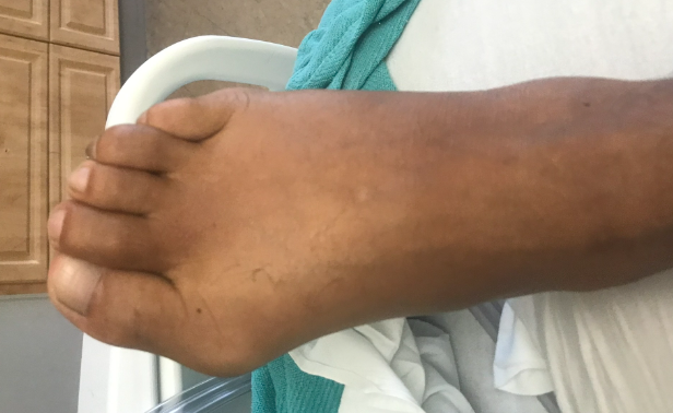 Image of patient foot featured in case report. | Credit: Brady Pregerson, MD