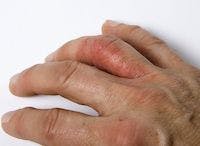 Tofacitinib Improves Quality of Life, Skin Symptoms In Psoriatic Arthritis