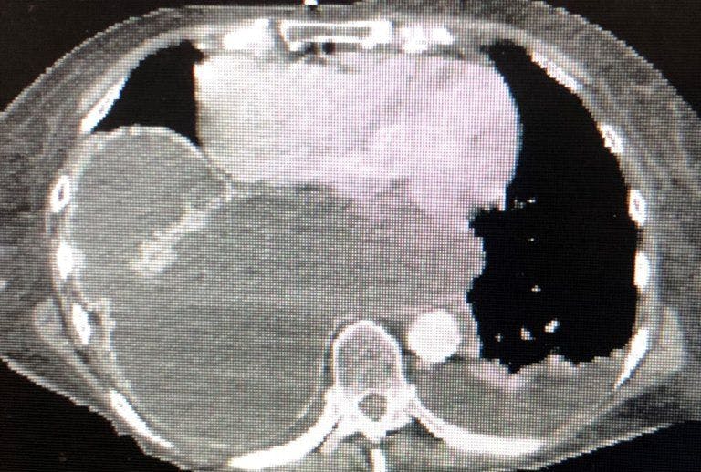 Photo of CT scan of abdomen