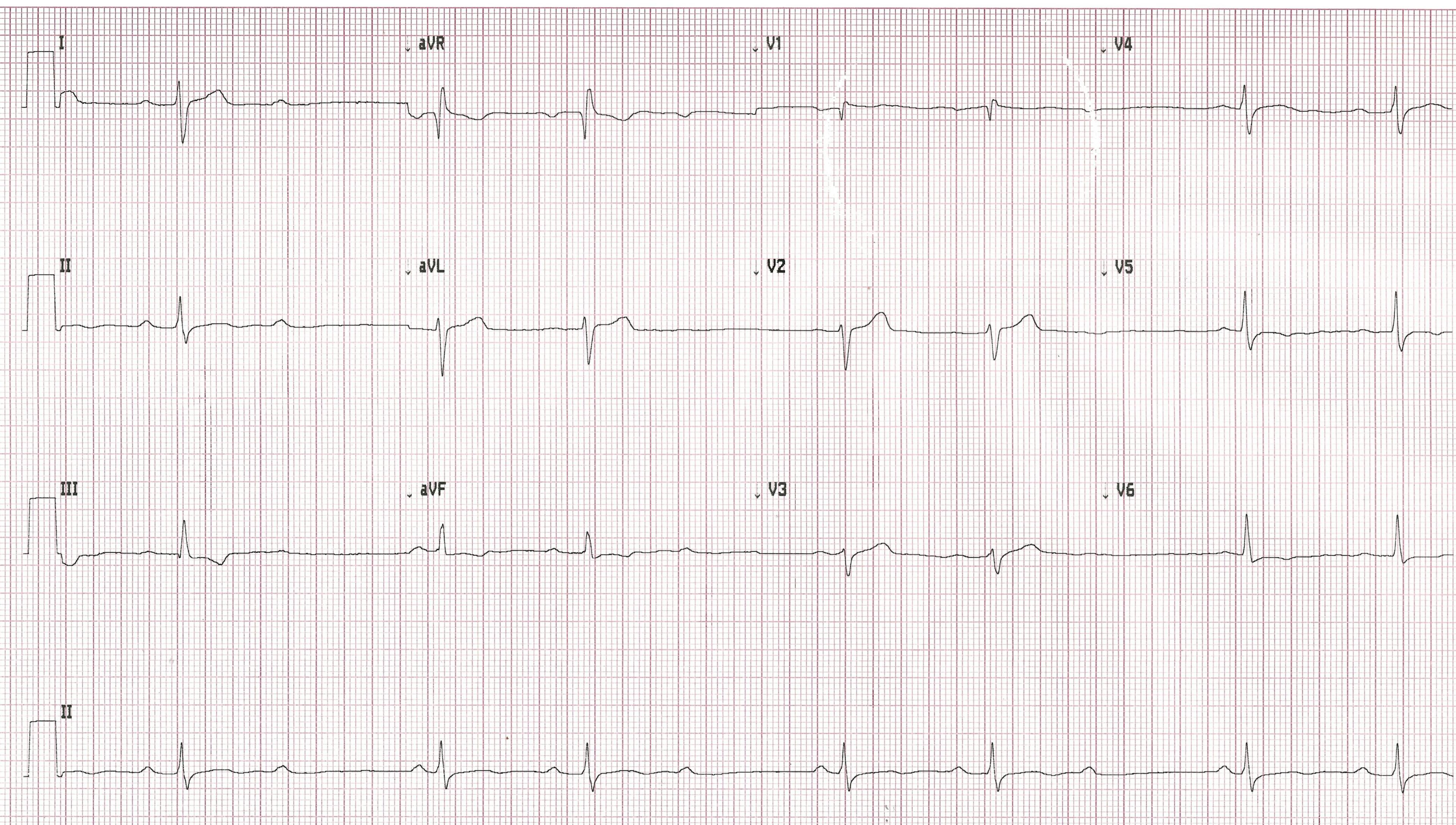 Printout of an ECG from a patient presenting to the emergency department. | Credit: Brady Pregerson, MD