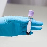 Blood Test Rules Out Rheumatoid Arthritis Medications that Won't Work
