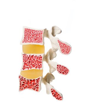 All about osteoporosis: A comprehensive analysis