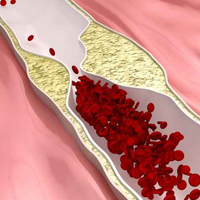 Metabolic Dyslipidemia Linked to CHD Risk in Diabetes Adults, Study Finds  
