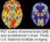 A Two- to Three-fold Increase in Alzheimer's Diagnoses?