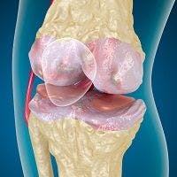 Injectable Bioactive Gel Heals Cartilage and Stops Osteoarthritis