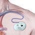 One-of-a-kind Clinical Trial to Study Use of Pacemakers