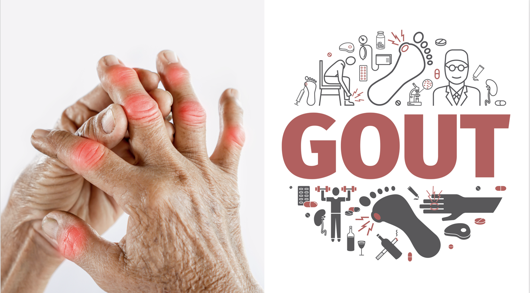 Combination Methotrexate and Pegloticase Therapy Proven More Effective Than Monotherapy in Patients With Gout