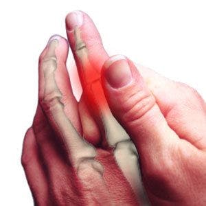 NSAIDs: The First Line of Defense for Psoriatic Arthritis