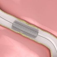 Which Stents Are Better: Drug-Eluting or Bare Metal?
