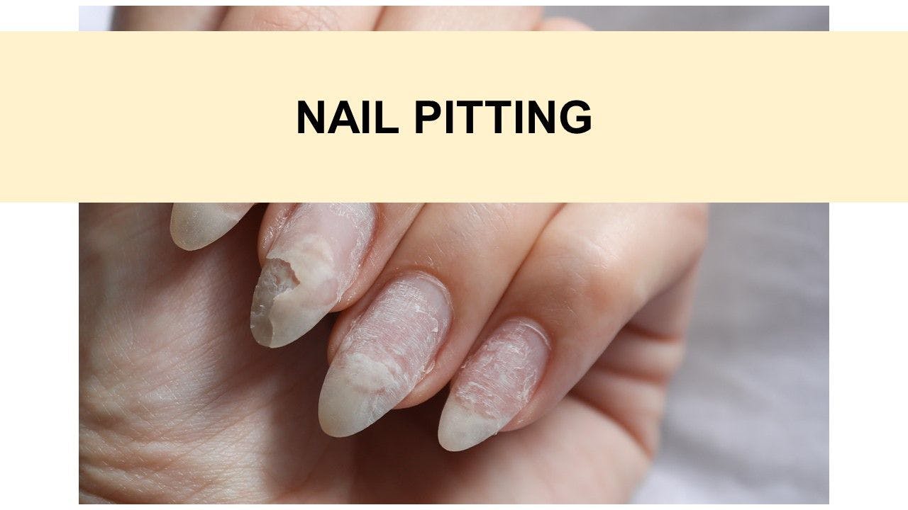 PsA Quiz:  Nail Pitting and Onycholysis