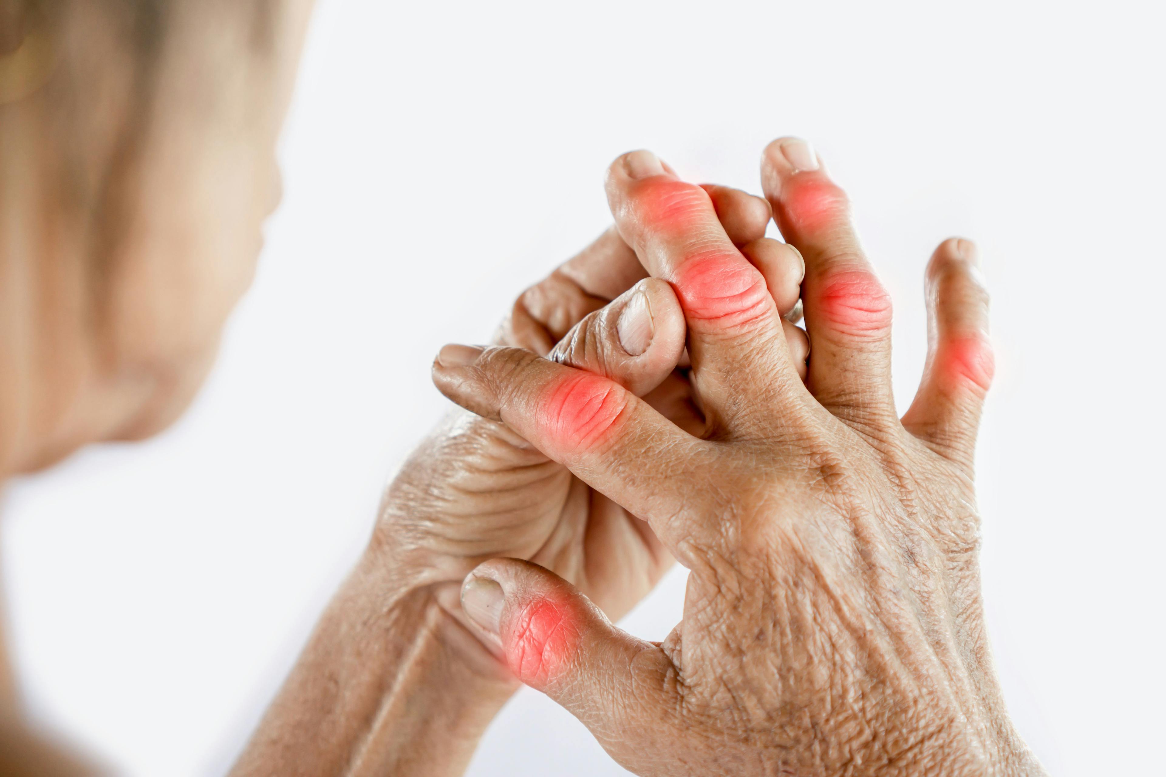 Steroid Injection Effectively Treats Psoriatic Hand Dactylitis 