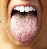 Microbiome of Tongue Coating Could Hold Clues Related to Heart Health