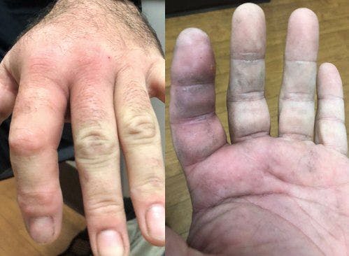 Case study photo of patient's swollen hands