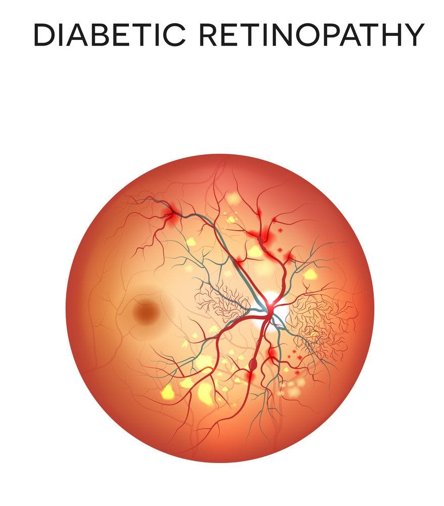 Undiagnosed Diabetic Retinopathy Prevalence
