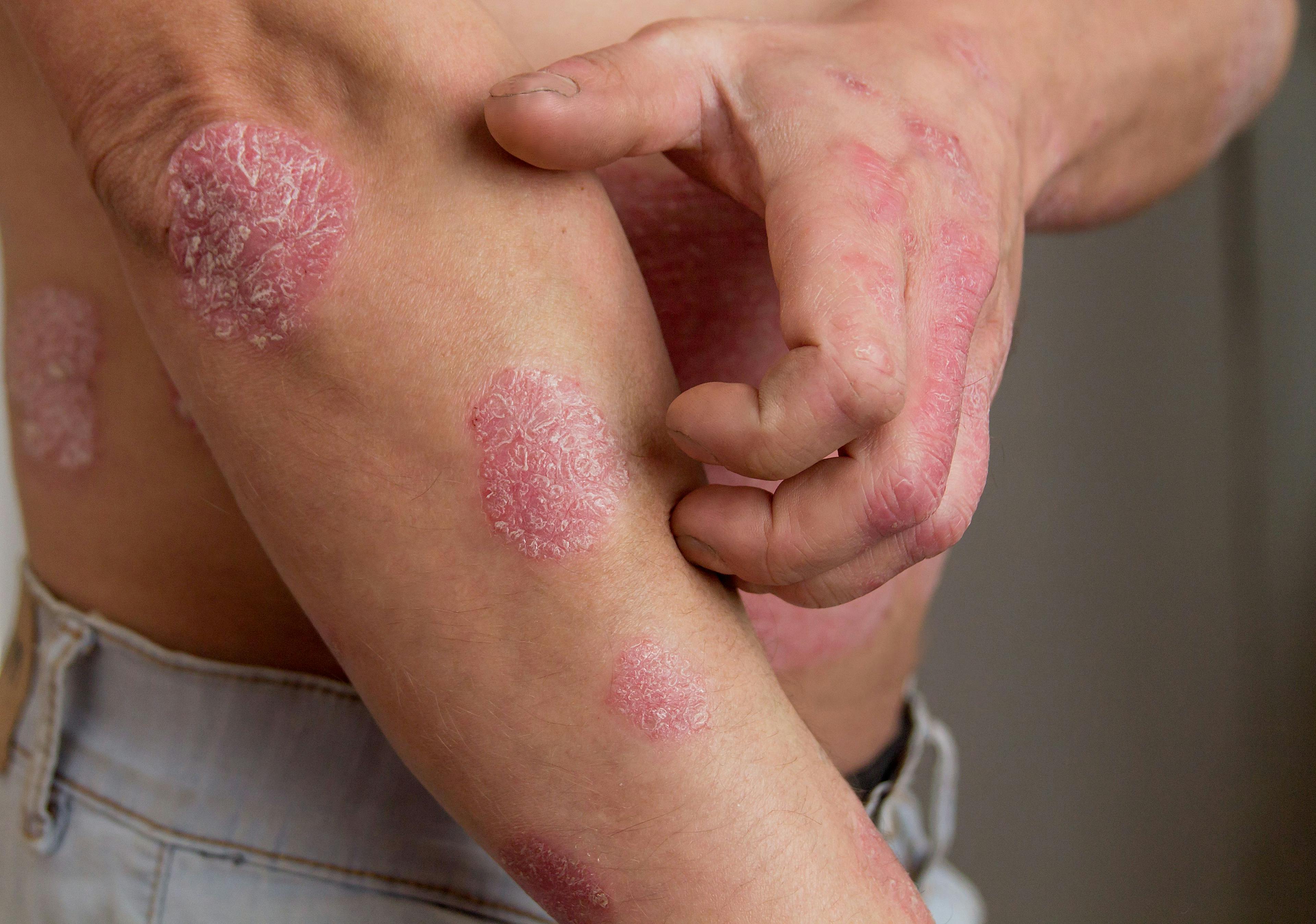 Psoriasis Linked to Greater Chance of Developing Psoriatic Arthritis