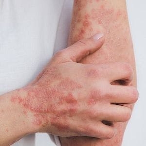 Study Compares Benefits of Treating Inverse Psoriasis with IL-17, IL-23 Inhibitors
