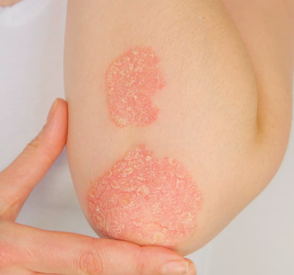 Specific Inflammatory Markers Linked to Psoriasis Area and Severity Scores