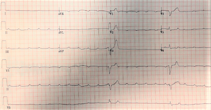EKG printout from patient experiencing bradycardia.