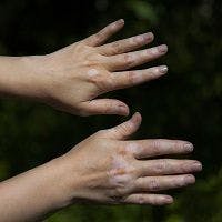 Case Study Points to Potential New Treatment for Patients with Vitiligo