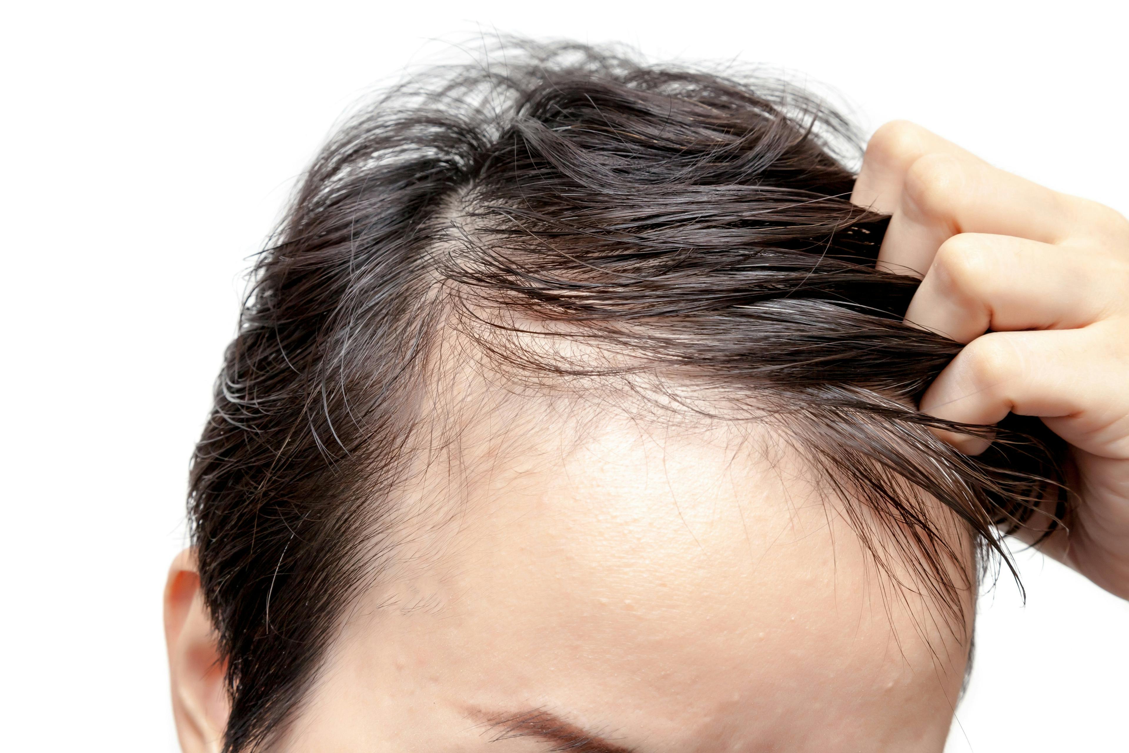 Oral JAK Inhibitors, Steroids Do Not Significantly Differ in Alopecia Hair Regrowth