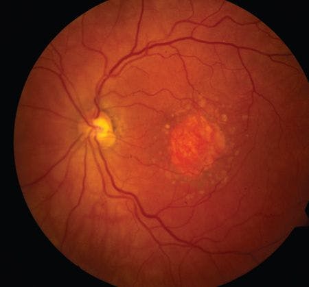 APL-2 Meets Primary Endpoint In AMD Patients With Geography Atrophy