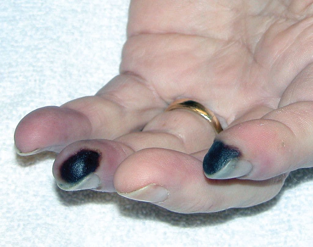 Ulcers and Gangrene in the Hands and Feet of a 56-Year-Old Man