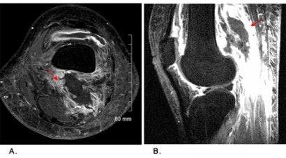 Diabetic Myonecrosis Presenting with Bilateral Knee Effusion