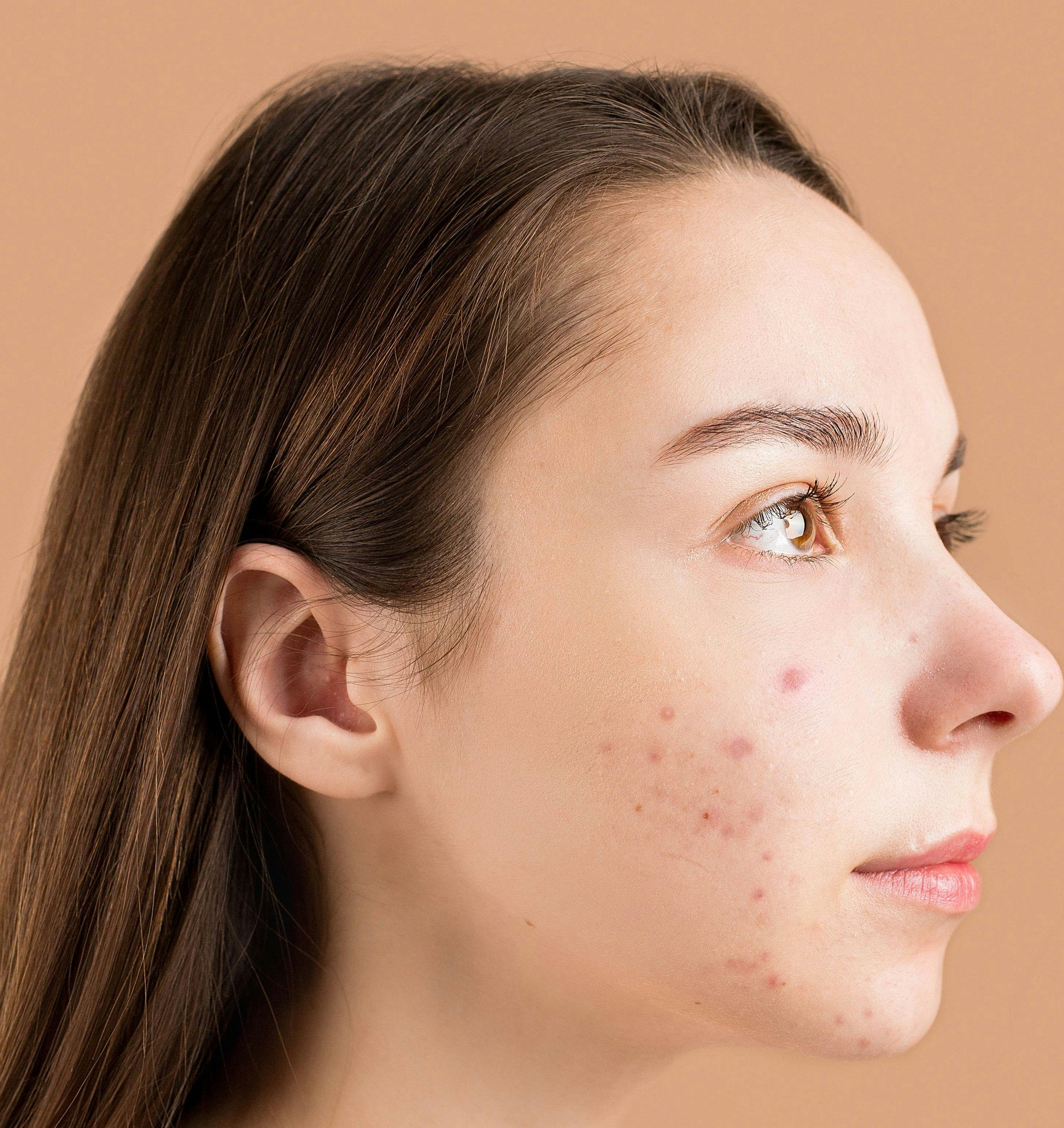 Clascoterone Cream Linked to Facial Acne Clearance in Adolescents, Adults at 12 Weeks