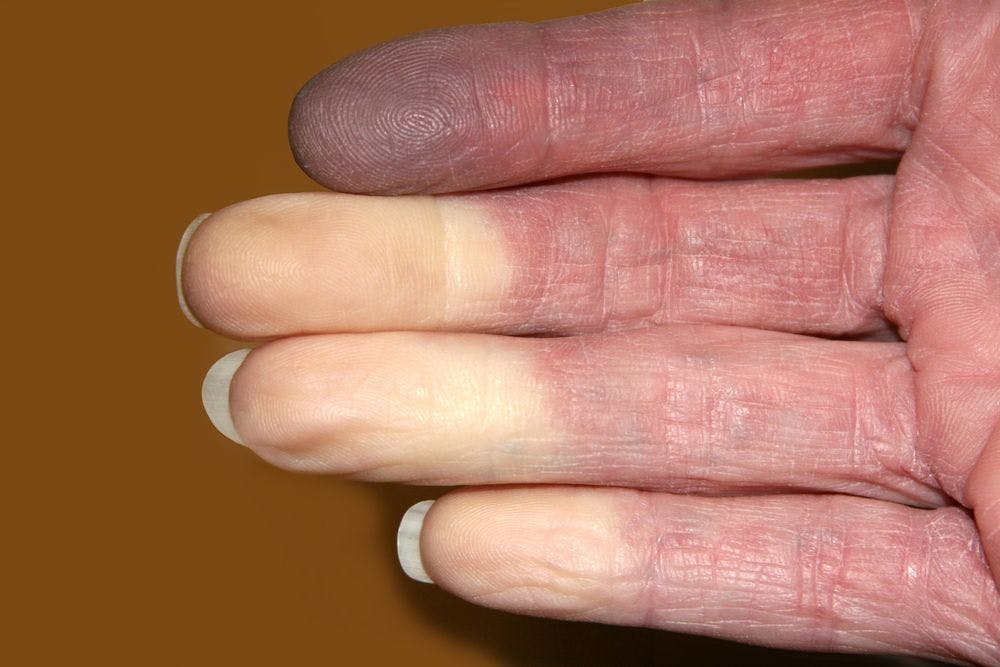 Abnormal Nail Folds may Suggest Abnormal  Pulmonary Function